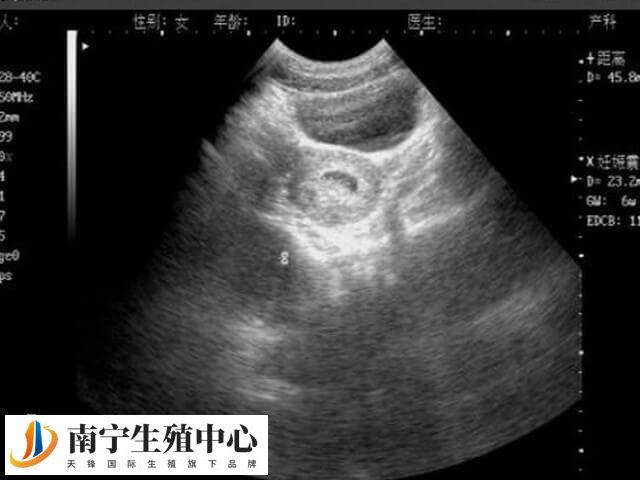 胎盘低置避免下蹲