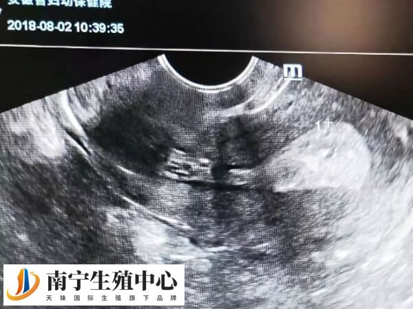 试管移植前内膜越来越薄怎么回事